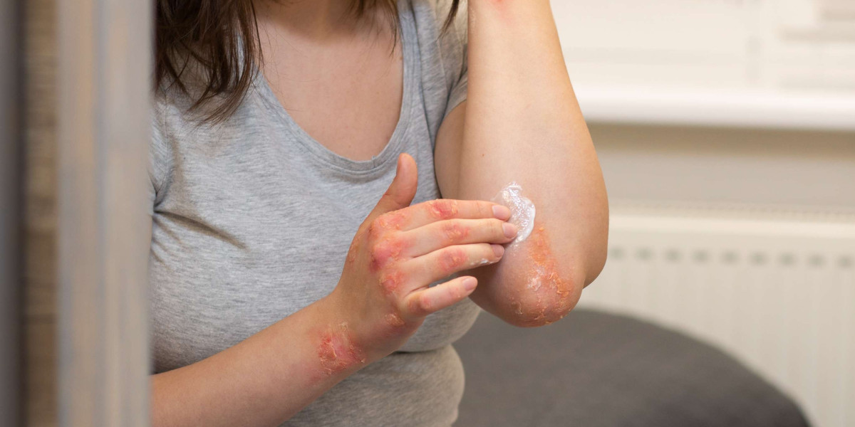 Ivercor 12 mg Tablet for Scabies – Proven Results at Affordable Bulk Pricing